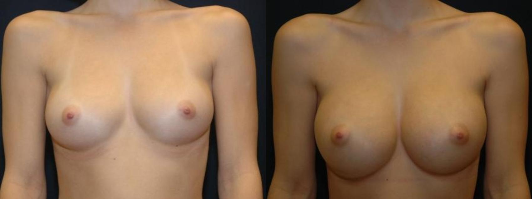 Front view of a woman before and after breast augmentation at our Eugene, OR, practice, taking her size from a B cup to a C cup.
