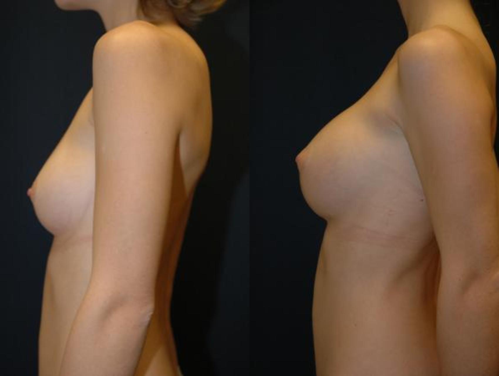 Breast Augmentation Before & After Photo | Eugene, OR | Mark L. Jewell, MD