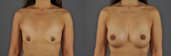 Before-and-after photos of a woman who had breast augmentation at Jewell Plastic Surgery in Eugene, OR.