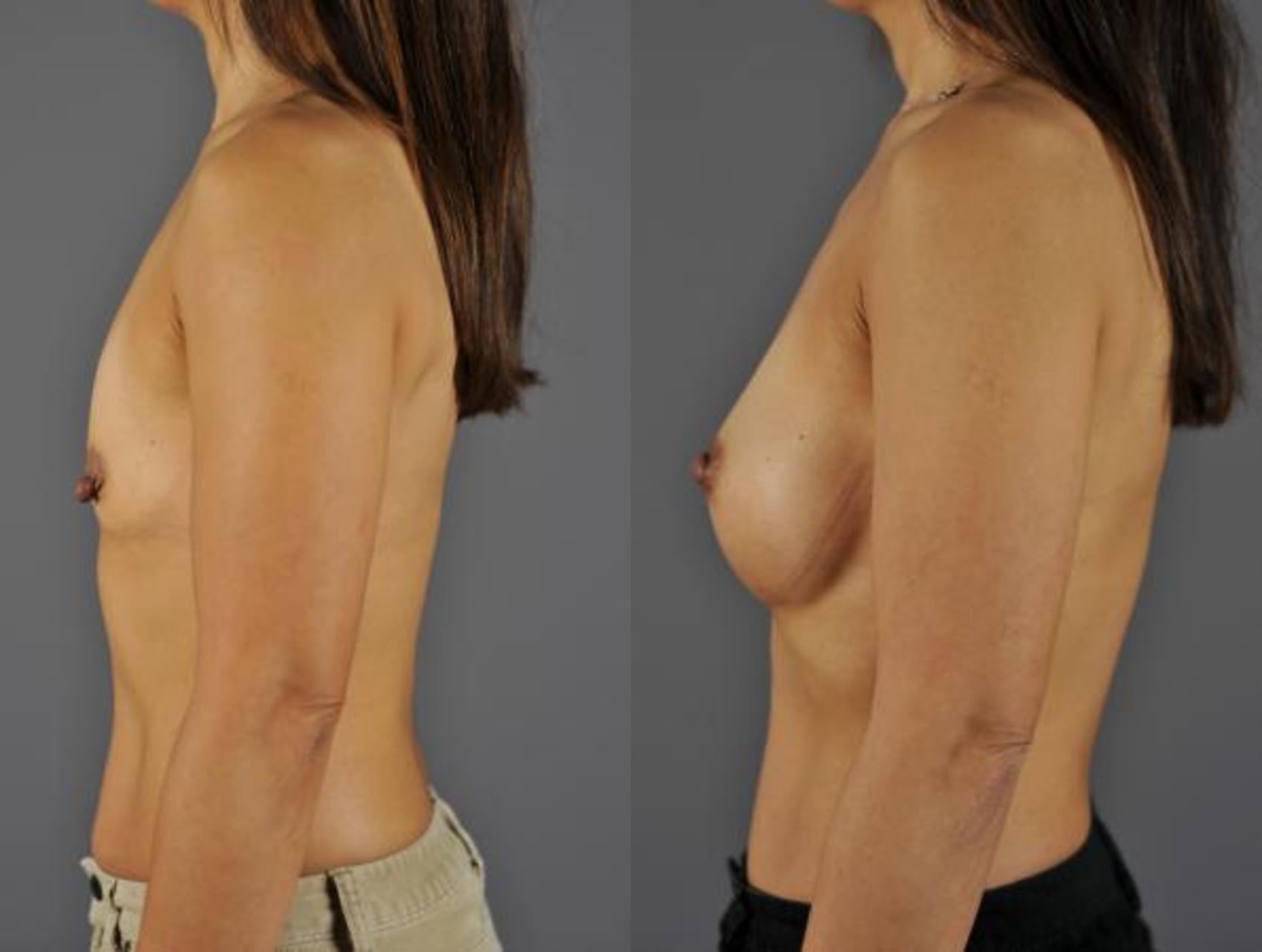 Breast Augmentation Before & After Photo | Eugene & Salem, OR | Mark L. Jewell, MD