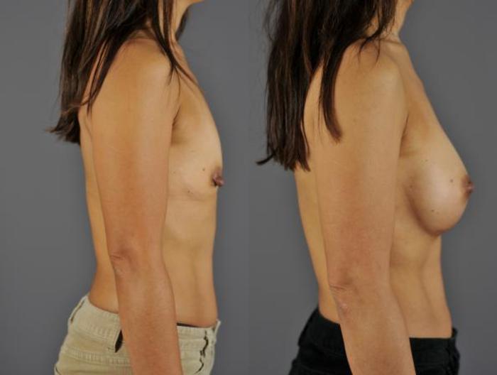 Breast Augmentation Before & After Photo | Eugene, OR | Mark L. Jewell, MD