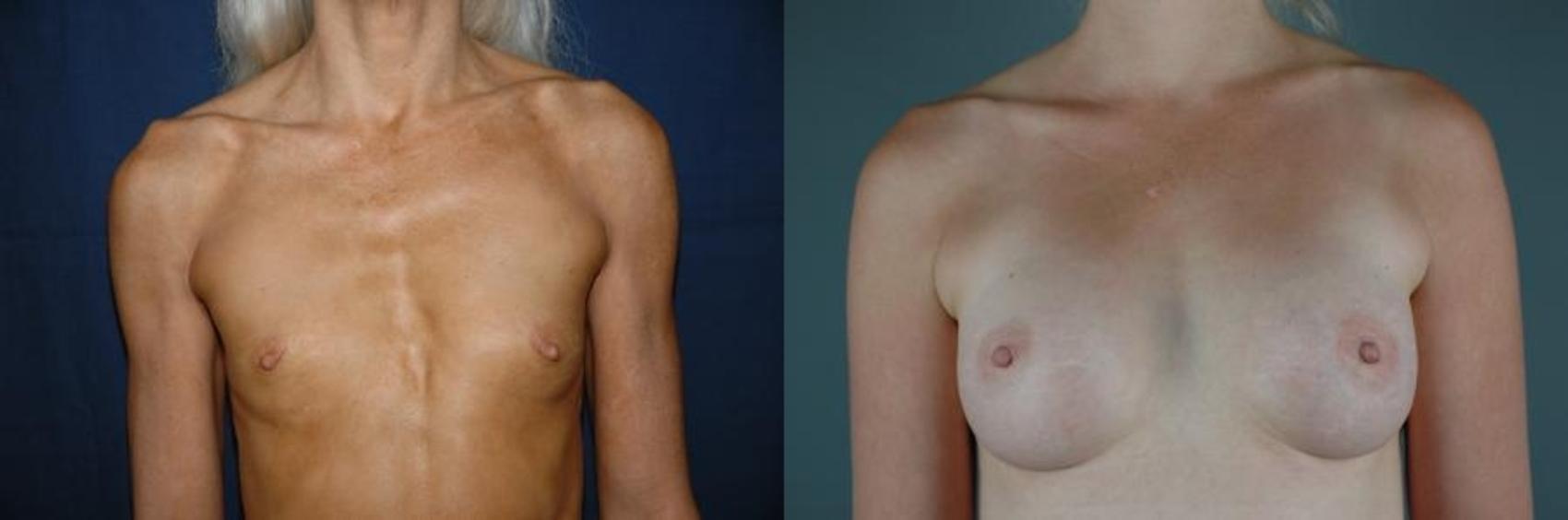 Front view of breast augmentation patient, a semi-pro bodybuilder, before and after breast implants at our Eugene, OR, practice.