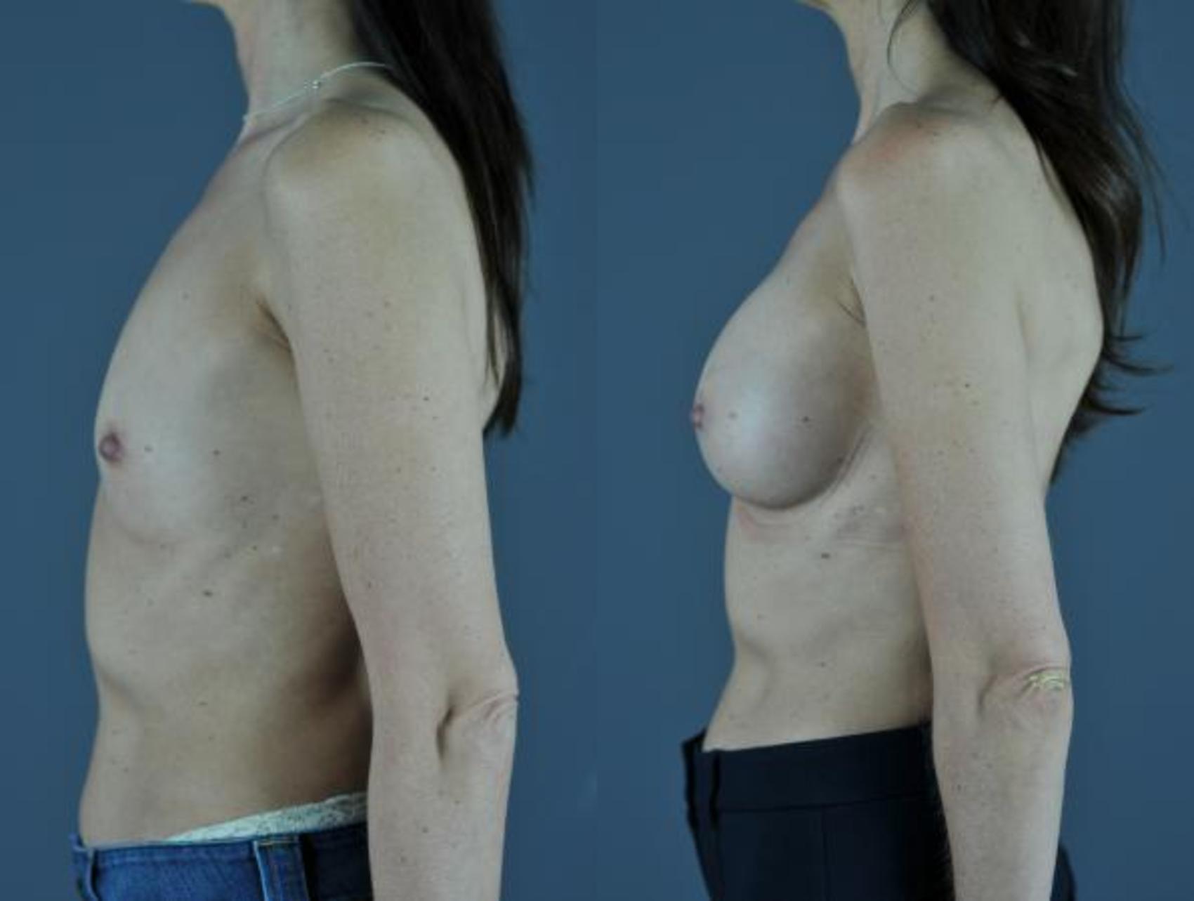 Breast Augmentation Before & After Photo | Eugene & Salem, OR | Mark L. Jewell, MD