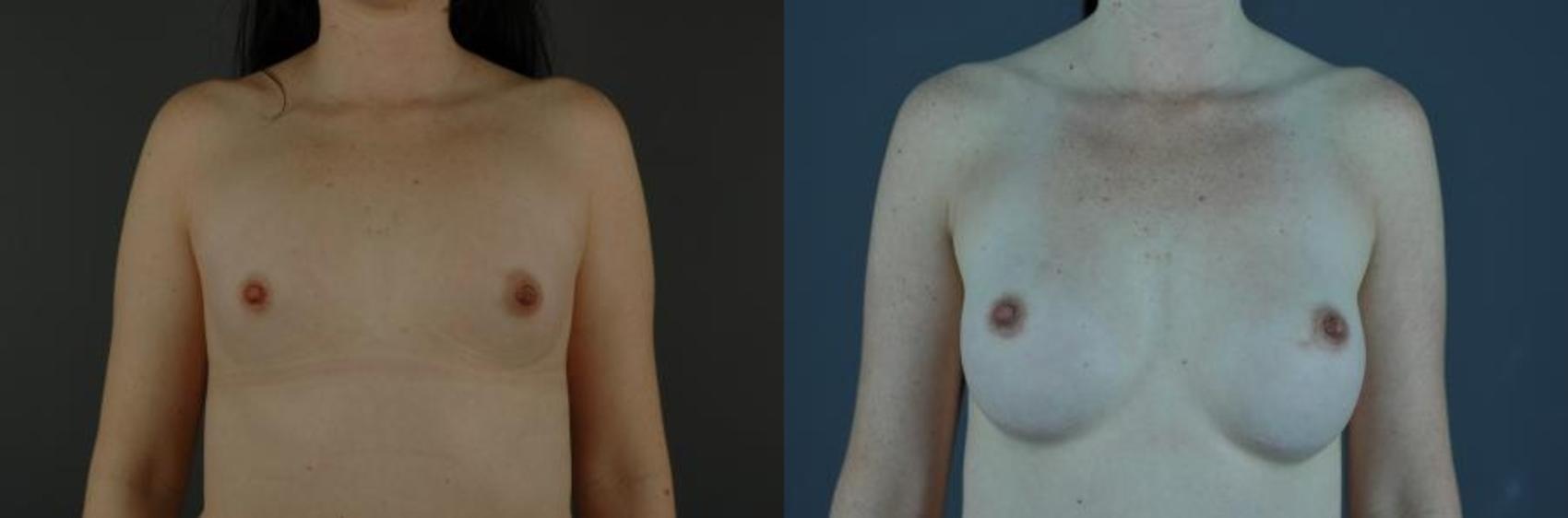 Woman’s A-cup sized breasts before breast augmentation at our Eugene, OR, practice, and her D-cup breasts after the surgery.