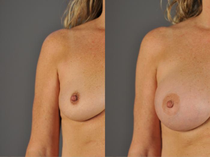 A woman's right breast before breast augmentation at our Eugene, OR, practice and her DD-cup bra size after.