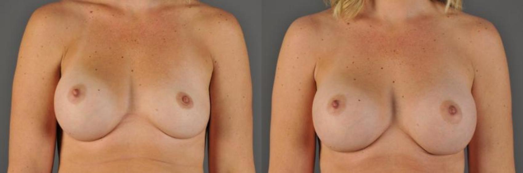 Breast Implant Exchange Before & After Photo | Eugene, OR | Mark L. Jewell, MD