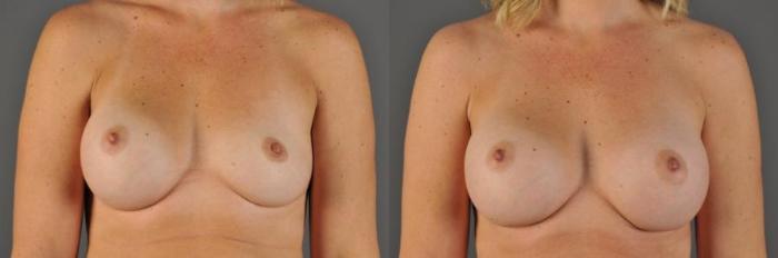 Breast Implant Exchange Before & After Photo | Eugene, OR | Mark L. Jewell, MD