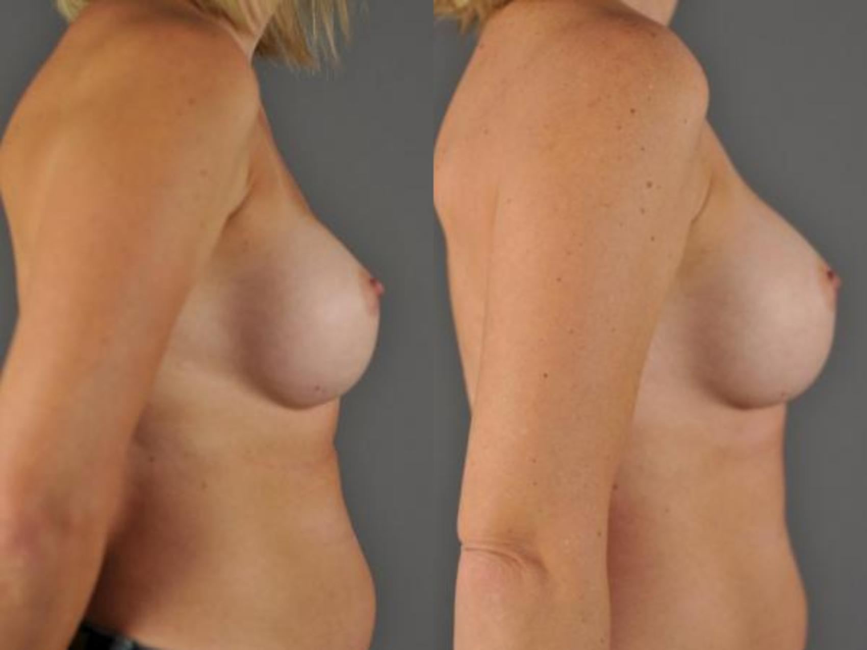 Breast Implant Exchange Before & After Photo | Eugene & Salem, OR | Mark L. Jewell, MD
