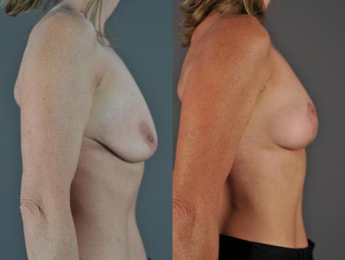 Breast Lift Before & After Photo | Eugene, OR | Mark L. Jewell, MD