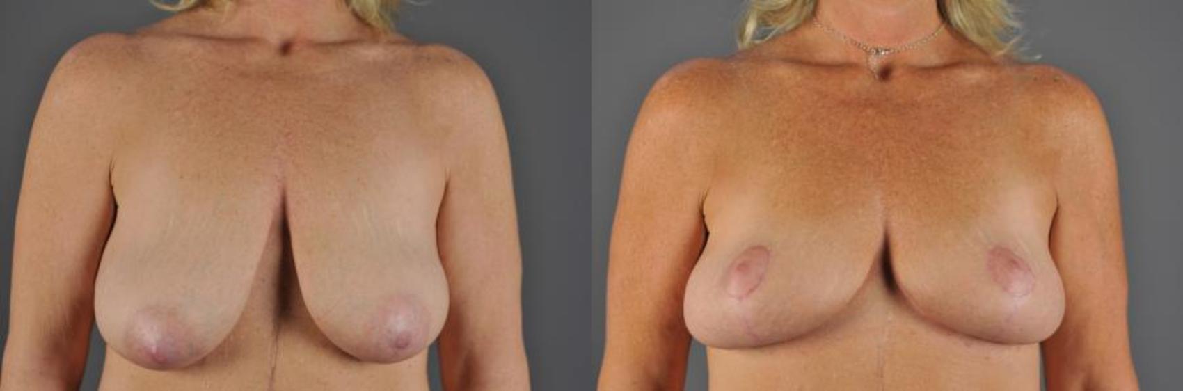 Breast Lift Before & After Photo | Eugene, OR | Mark L. Jewell, MD