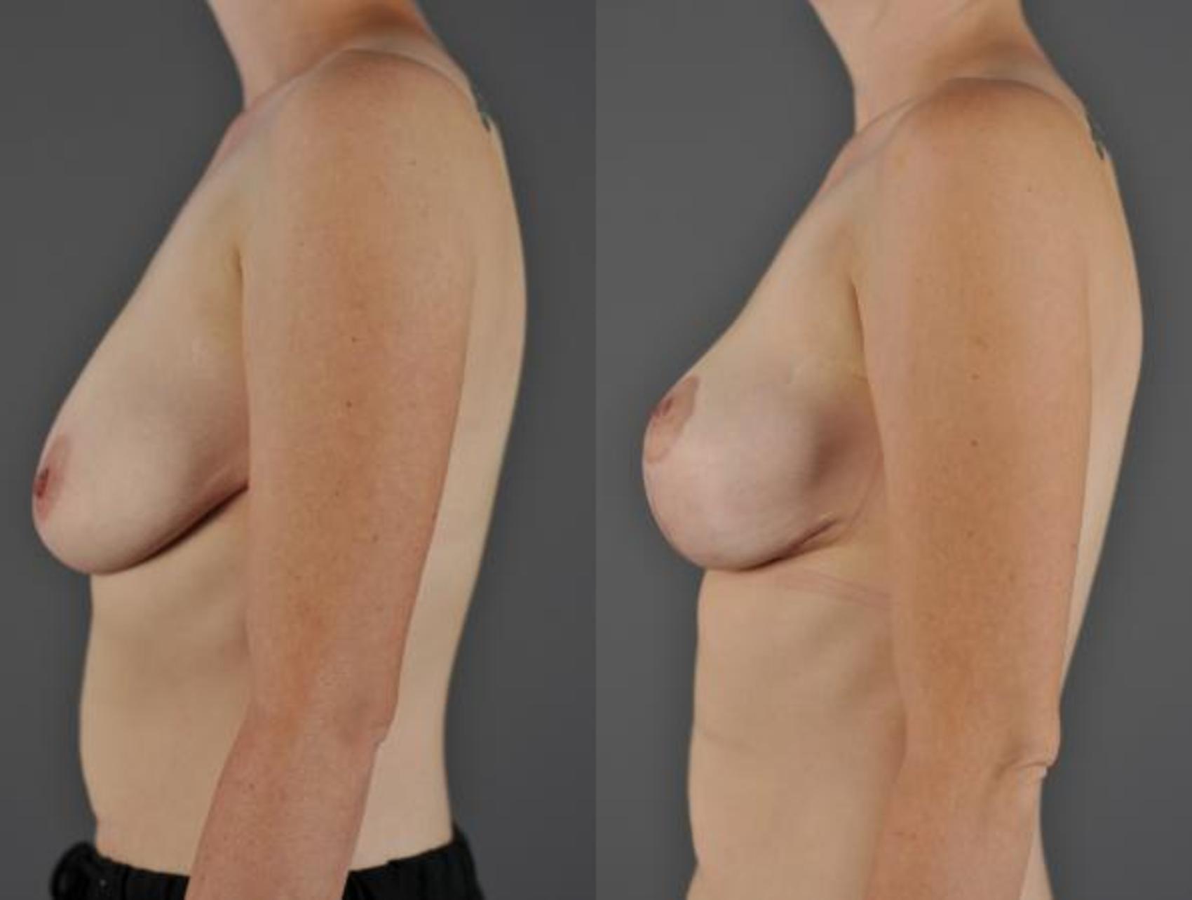 Breast Lift Before & After Photo | Eugene & Salem, OR | Mark L. Jewell, MD