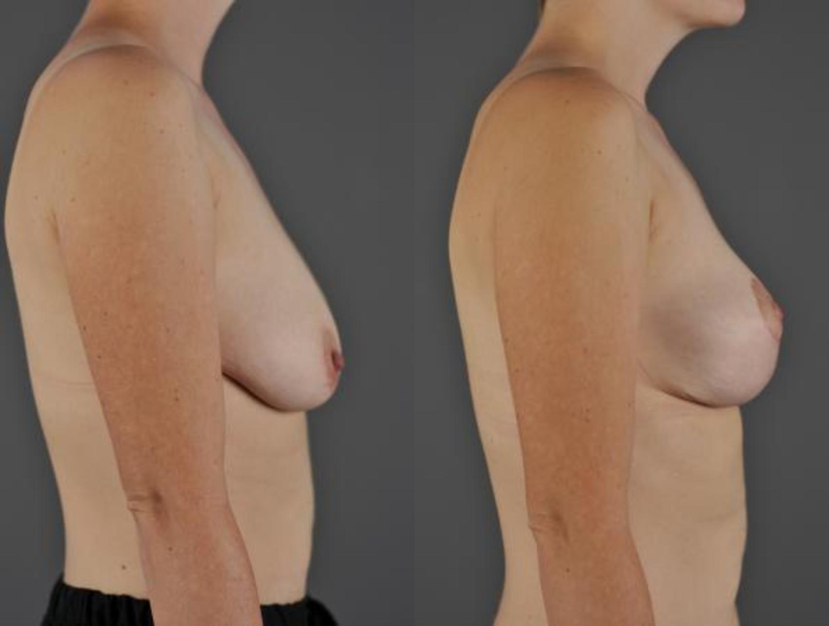 Breast Lift Before & After Photo | Eugene & Salem, OR | Mark L. Jewell, MD