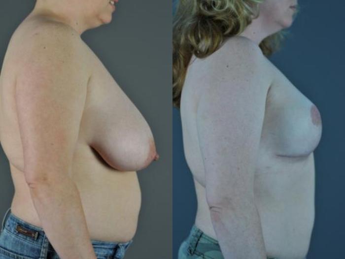Breast Reconstruction Before & After Photo | Eugene, OR | Mark L. Jewell, MD