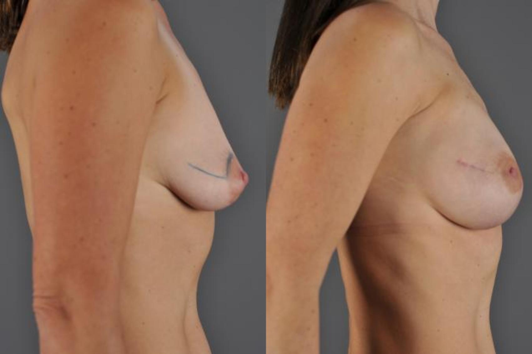 Breast Reconstruction Before & After Photo | Eugene & Salem, OR | Mark L. Jewell, MD