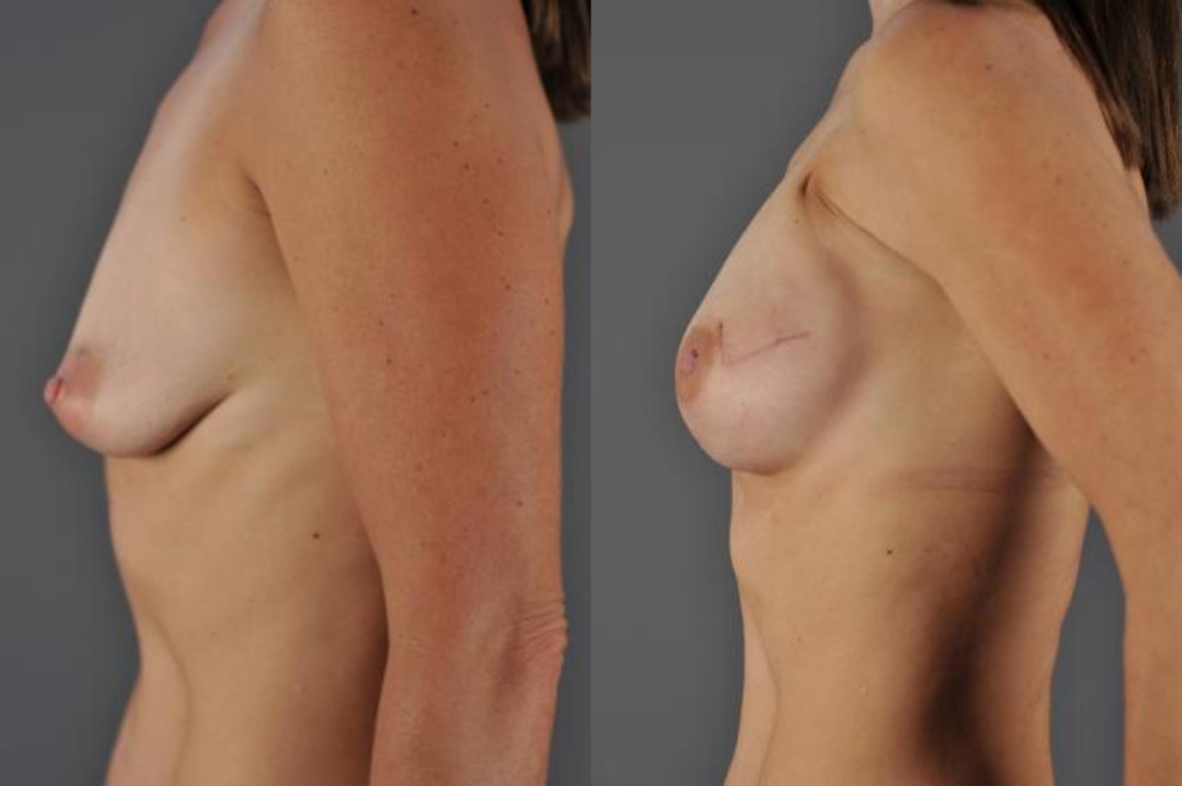 Breast Reconstruction Before & After Photo | Eugene & Salem, OR | Mark L. Jewell, MD