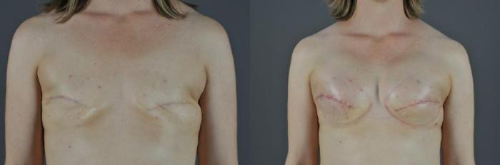 Breast Reconstruction: Patient 3; Before and 1 Month After