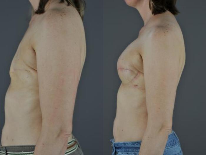 Mastectomy Breast Prostheses