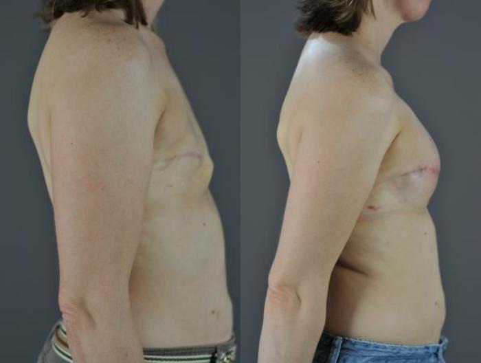 Breast Reconstruction Before & After Photo | Eugene, OR | Mark L. Jewell, MD