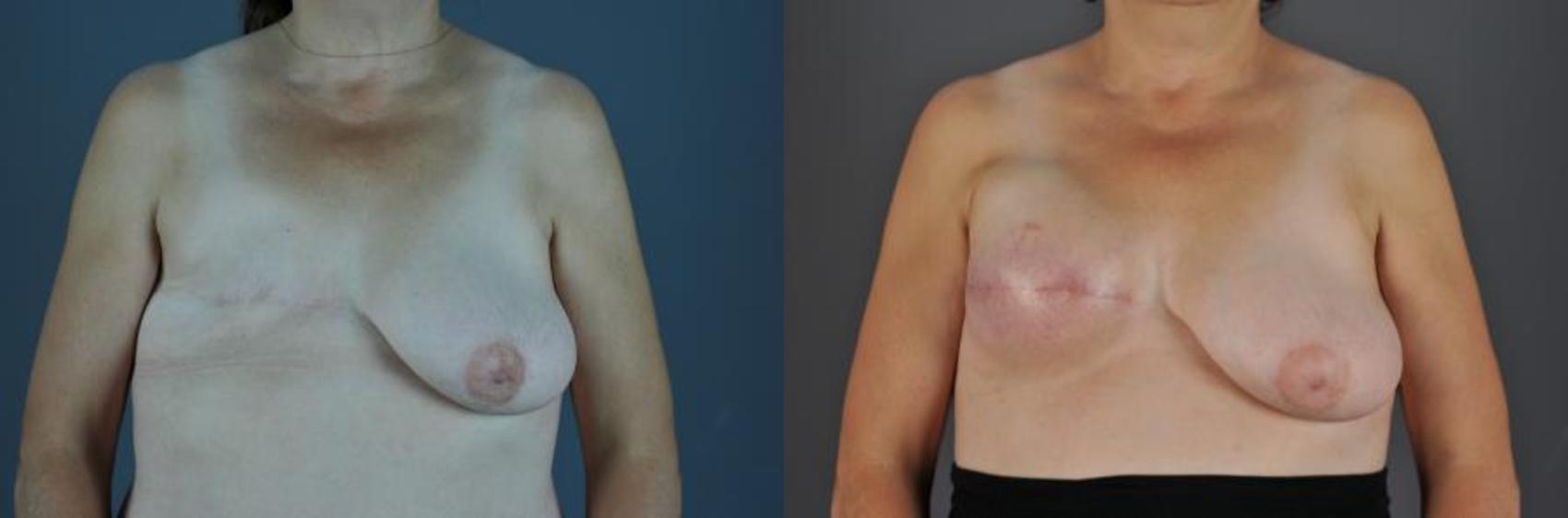 Breast Reconstruction Before & After Photo | Eugene, OR | Mark L. Jewell, MD