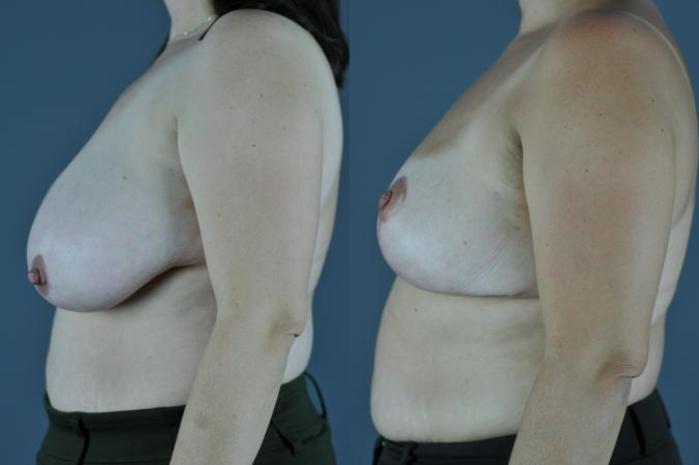Breast Reduction Before & After Photo | Eugene, OR | Mark L. Jewell, MD