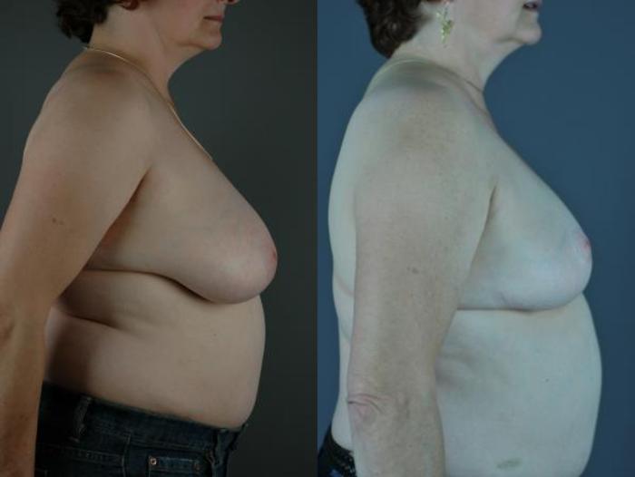 Breast Reduction Before & After Photo | Eugene, OR | Mark L. Jewell, MD