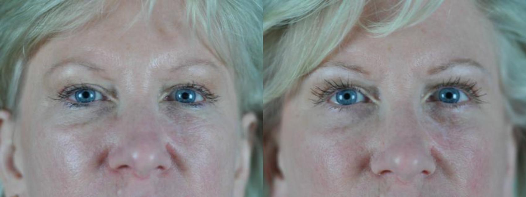 Facelift Before & After Photo | Eugene & Salem, OR | Mark L. Jewell, MD