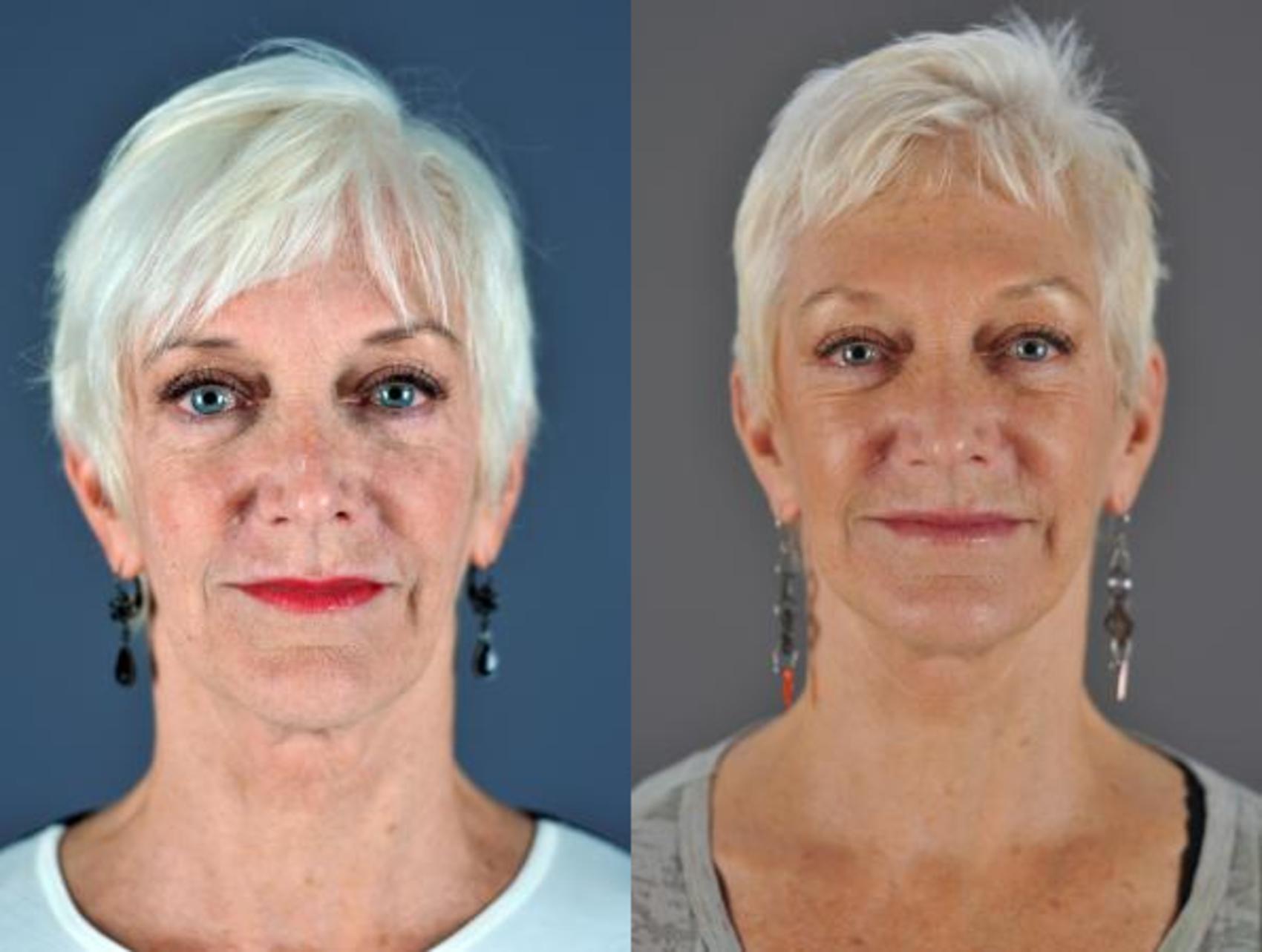 Facelift Before & After Photo | Eugene, OR | Mark L. Jewell, MD