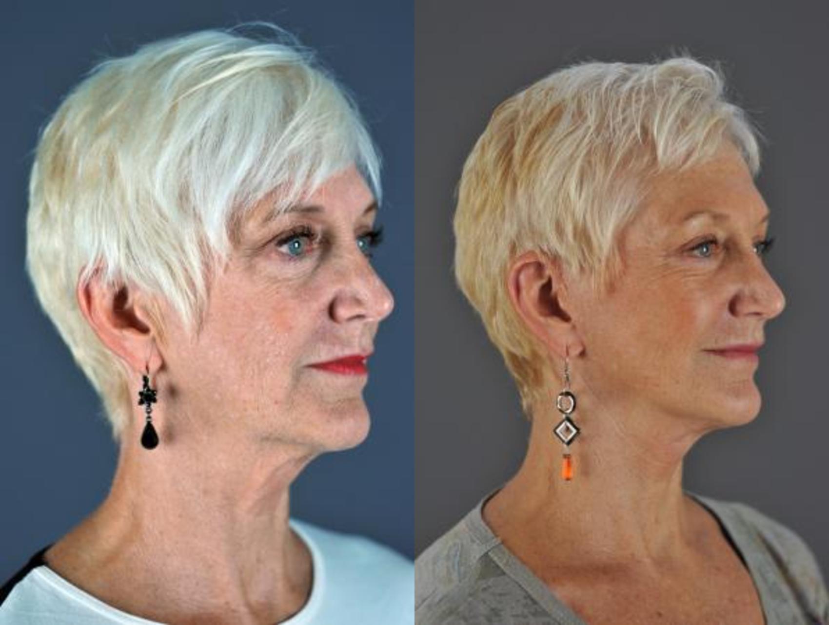 Facelift Before & After Photo | Eugene, OR | Mark L. Jewell, MD