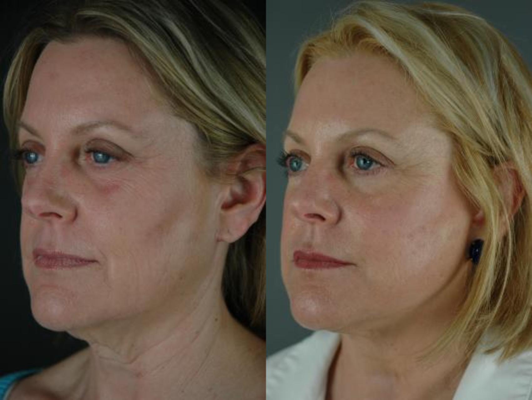 Facelift Before & After Photo | Eugene & Salem, OR | Mark L. Jewell, MD