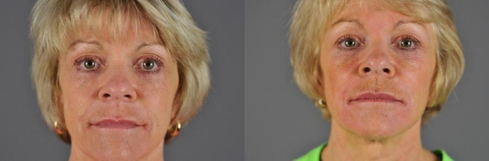 Fillers Before & After Photo | Eugene, OR | Mark L. Jewell, MD