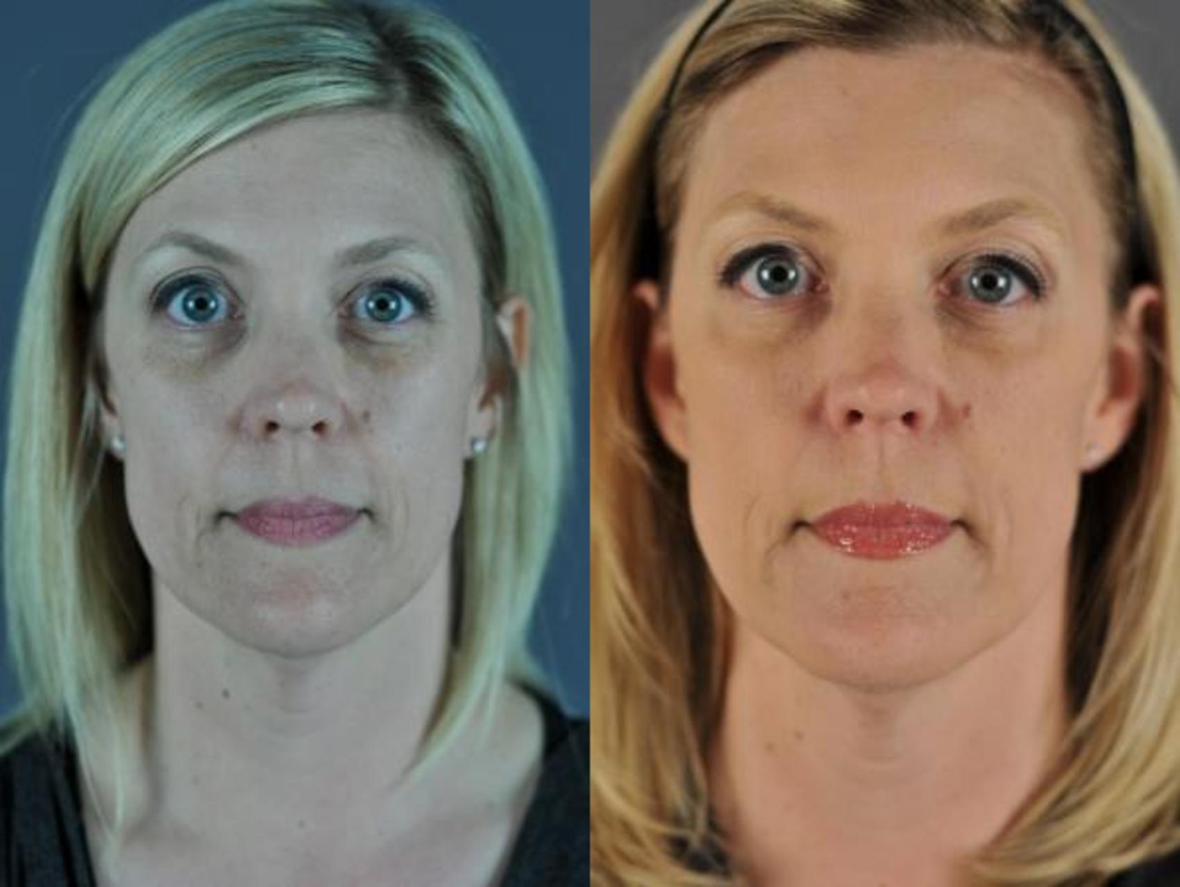Fillers Before & After Photo | Eugene, OR | Mark L. Jewell, MD
