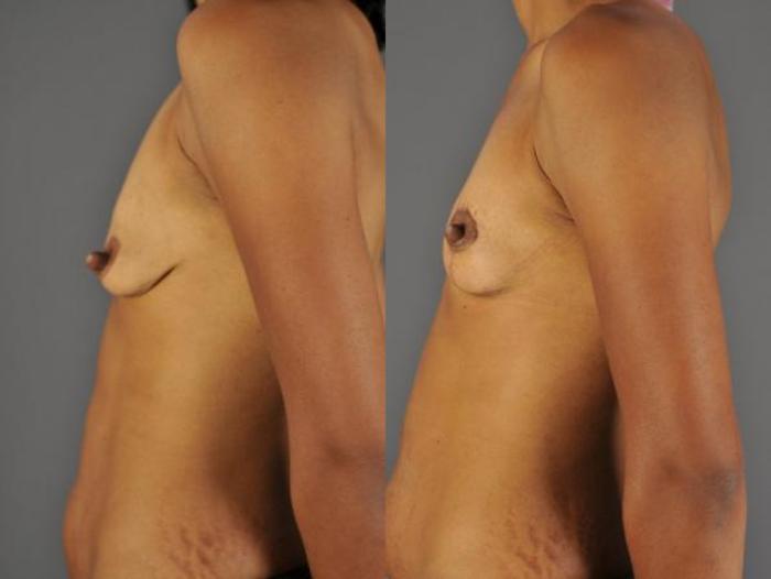 Mastopexy-Augmentation Before & After Photo | Eugene, OR | Mark L. Jewell, MD