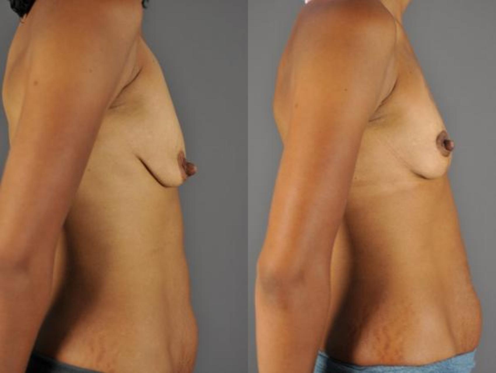 Mastopexy-Augmentation Before & After Photo | Eugene & Salem, OR | Mark L. Jewell, MD
