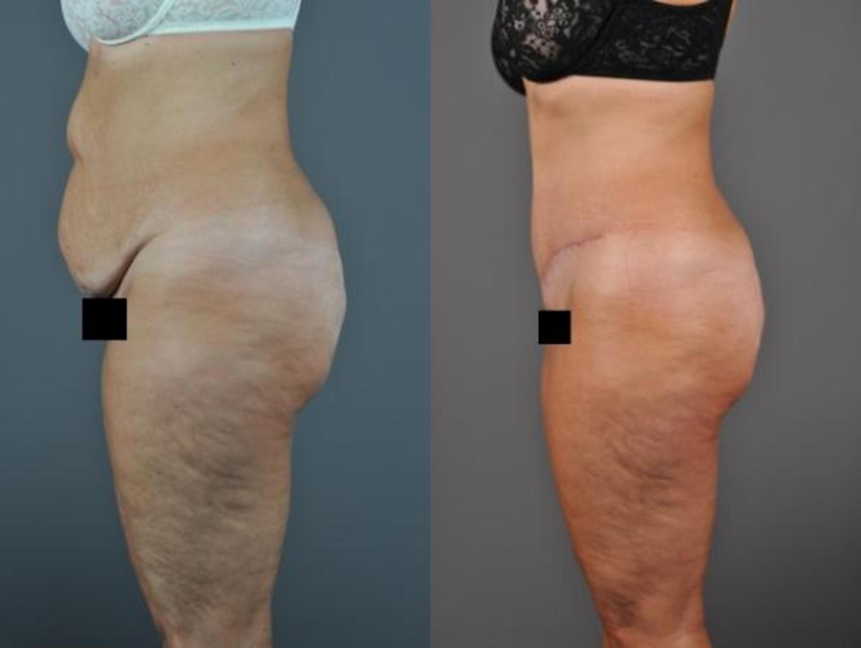 Tummy Tuck Before & After Photo | Eugene & Salem, OR | Mark L. Jewell, MD