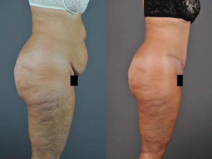Tummy Tuck Before & After Photo | Eugene, OR | Mark L. Jewell, MD
