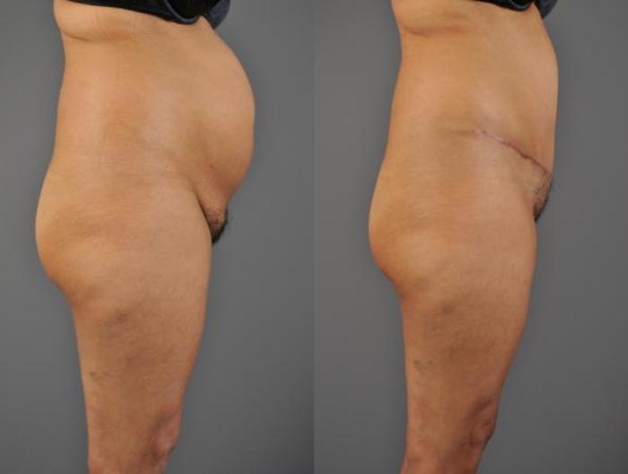 Tummy Tuck Before & After Photo | Eugene, OR | Mark L. Jewell, MD