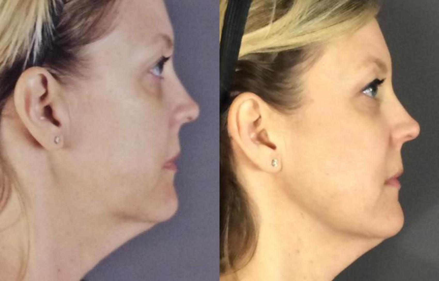 Ultherapy® Before & After Photo | Eugene, OR | Mark L. Jewell, MD