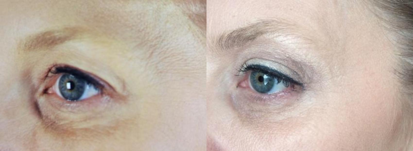 Ultherapy® Before & After Photo | Eugene & Salem, OR | Mark L. Jewell, MD