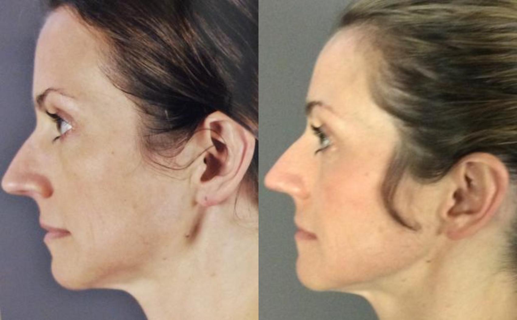 Ultherapy® Before & After Photo | Eugene, OR | Mark L. Jewell, MD