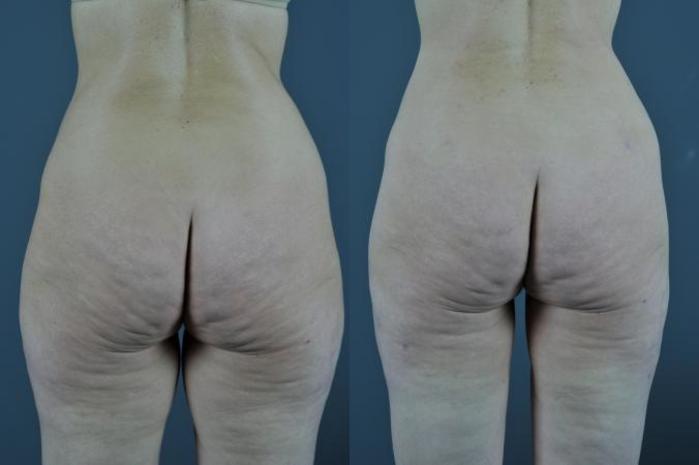 VASER® Lipo Before & After Photo | Eugene, OR | Mark L. Jewell, MD
