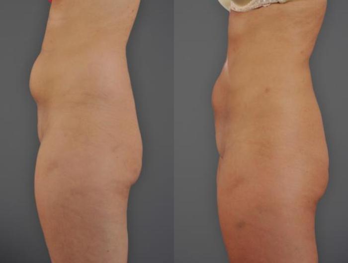 VASER® Lipo Before & After Photo | Eugene, OR | Mark L. Jewell, MD